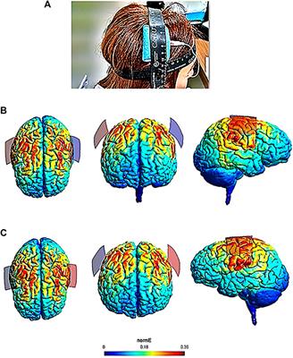 Bilateral Motor Cortex tDCS Effects on Post-Stroke Pain and Spasticity: A Three Cases Study